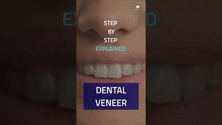 Dental veneer Step by step EXPLAINED shorts [upl. by Fanchet]