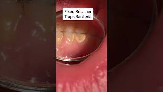 Retainers keep teeth together Removable retainers vs fixed retainer cosmeticdentistry retainers [upl. by Pederson787]