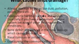 Sinus Drainage [upl. by Kenimod242]