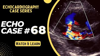 Echocardiography Case 68 Echo Spot Diagnosis Series  Echo Interpretation Made Easy [upl. by Namyl]