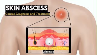 Skin Abscess Causes Signs and Symptoms Diagnosis and Treatment [upl. by Lerred]