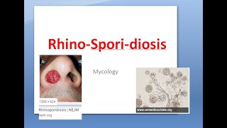 Microbiology 580 a RhinoSporidiosis RhinoSporidium seeberi polyps nose diagnosis spherules mycosis [upl. by Ahsienal349]