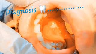 What is your diagnosis8 White patch extending on hard palate premalignant keratotic lesions [upl. by Viehmann]