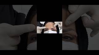 blepharoplasty gone wrong [upl. by Bremser]