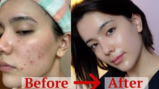 how I got rid of my ACNE after 8 years  ONLY thing worked [upl. by Golightly257]