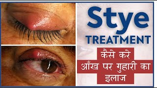 Easy Stye treatment at Home  Doctors tips for Stye Eye infection  कैसे करे आँख पर गुहरी का इलाज [upl. by Aicenat161]