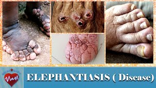 WHAT IS ELEPHANTIASIS DISEASE  CAUSES SYMPTOMS AND TREATMENT OF ELEPHANTIASIS  BIG FOOT DISEASE [upl. by Eardna]