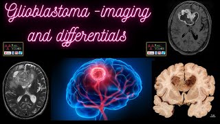 GlioblastomaImaging and differential diagnosis [upl. by Ardiedak]