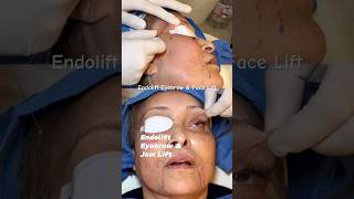 ENDOLIFT Eyebrow amp Facelift  Full Treatment amp Review [upl. by Cutter]