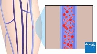 How superficial thrombophlebitis develops [upl. by Barthelemy]