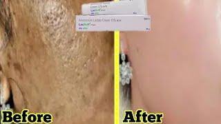 Lacsoft Cream  Remove Pigmentation  Dark spot  Acne amp Acne scars  Brijwasi Girl [upl. by Batholomew]