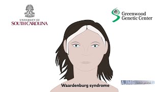 Biallelic deletions of the Waardenburg II syndrome gene SOX10 cause a recognizable arthrogryposis [upl. by Carroll]