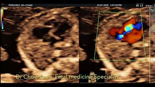 Ebsteins anomaly by Dr Chowhan S Fetal Medicine Specialist [upl. by Ecniuq481]