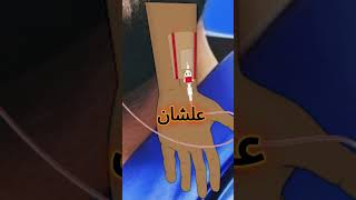 ليه بنركب الكانيولا الشريانية للمريض ؟  arterial cannula  arterial line [upl. by Gnuoy815]