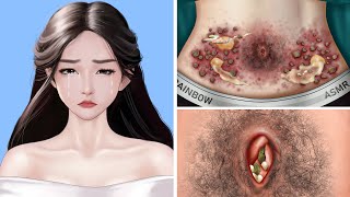 ASMR Remove Big Acne amp Worm Infected Belly  Deep Cleaning Animation [upl. by Melita]