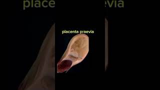 Placenta praevia shorts anatomy placentaprevia placenta gynecology [upl. by Irahc566]