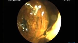 Direct Cholangioscopy with Standard Ultraslim Endoscopes [upl. by Vevine]