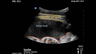 Ultrasound guided drainage of Ascites [upl. by Natam]