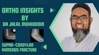 Dr Jalal Orthopedics made easySUPRACONDYLAR HUMERUS FRACTURE [upl. by Keeley]