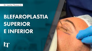 BLEFAROPLASTIA SUPERIOR E INFERIOR EM HOMEM  DR LAERTES THOMAZ JR [upl. by Sorazal971]