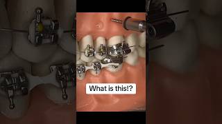 What are TADs for braces patients braces bracestips tads orthodontics dental orthodontist [upl. by Adnelg]