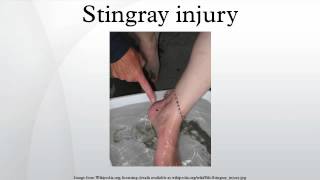 Stingray injury [upl. by Eimot628]