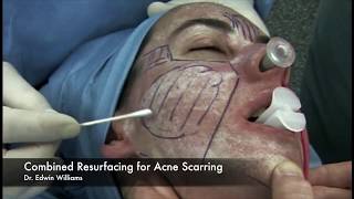 Laser amp Dermabrasion Treatment for Acne Scarring by Dr Edwin Williams [upl. by Aronoh964]