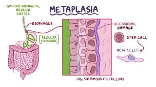 4 13 Metaplasia and dysplasia [upl. by Fosdick638]