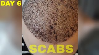 Hair Transplant Results DAY 6 FUE Turkey [upl. by Oretna]