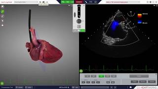 HeartWorks Atrial Septal Defect [upl. by Nadruoj]