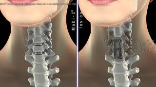 LDR MobiC cervical disc [upl. by Pliam651]