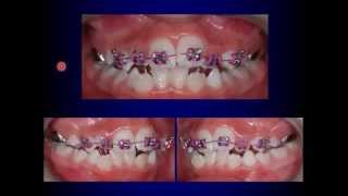 Fixed Orthodontic Appliances in the Mixed Dentition [upl. by Rhett]