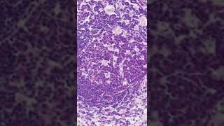 Toxoplasma Lymphadenitis Histology [upl. by Nima]