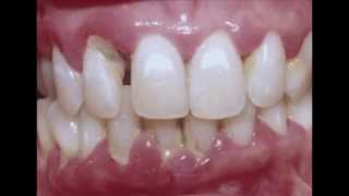 Periodontitis  Cure your Gum with Dr Mark Bonner [upl. by Aurelia]