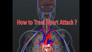 MONA Your First Response to Myocardial Infarction With Fraterne ZU medicalexcellencecenter [upl. by Ahsiemaj]