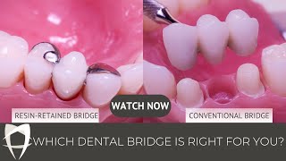 Resin Bonded Bridges vs Conventional Bridges  Missing Tooth [upl. by Leverett]