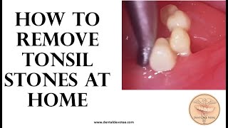 How to remove tonsil stones at home  Tonsil stone removal [upl. by Obeded]