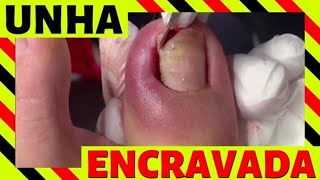 UNHA ENCRAVADA UNHA INFLAMADA VÍDEO SATISFATÓRIO [upl. by Rafat]