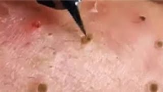 Full Giant Blackheads Popping Video Blackheads Removal 2019 [upl. by Tada]