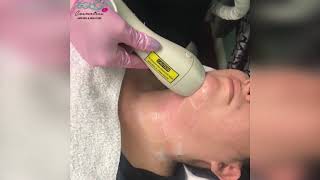 VelaShape – treating that stubborn double chin  BY BGMG MEDSPA [upl. by Joselow]