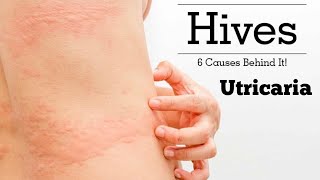 Urticaria Hives डाबर आउने समस्या के हो   DrRupak Ghimire [upl. by Iblok305]