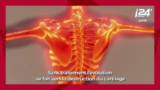 LA MINUTE SANTE  La polyarthrite rhumatoïde origines symptômes et traitements [upl. by Kylen665]