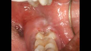 Operculectomy procedure with blade Painful swollen gum around wisdom tooth Pericoronitis Treatment [upl. by Goldie]