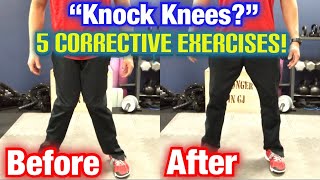 quotKnock Kneesquot Genu Valgum 5 BEST CORRECTIVE EXERCISES  Dr Wil amp Dr K [upl. by Ecilef]