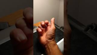 Simple rehabilitation for mallet finger after partial removal of splint [upl. by Anerda]