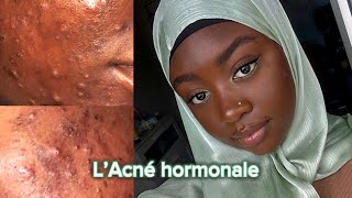 SKINCARE COMMENT J’AI SAUVÉE MON VISAGE … [upl. by Launam]