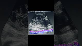 Placenta Mass  Chorangioma  Normal Fetal Scan  Anomaly Ultrasound [upl. by Gentry]