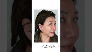 Combination Treatment  Aqualyx pdothreads and Meline  Clinicbe beauty aesthetics skin [upl. by Oiceladni]