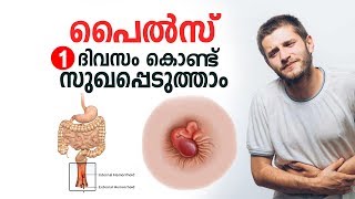 പൈൽസ് ഒരു ദിവസം കൊണ്ട് സുഖപ്പെടുത്താം  Piles Malayalam Health Tips [upl. by Shanie]