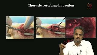 Lec 35 Spinal micro neuro Surgery [upl. by Drucill361]